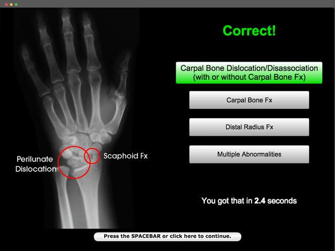 plm-wrist-x-ray