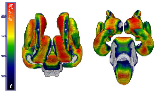 Lutkenhoff_SubcorticalAtrophy_pat
