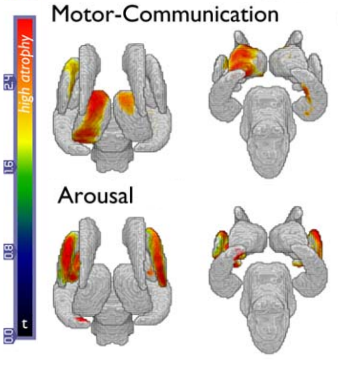 Lutkenhoff_SubcorticalAtrophy_patOnly